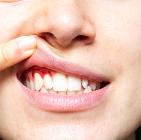 Periodontoloji (Diş Eti Hastalıkları)