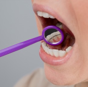 Periodontal Splint